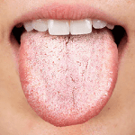Bílý povlak na jazyku: Co z toho vyvodit?