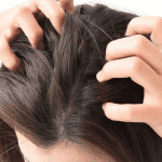 Pupínky ve vlasech: Jak se jich zbavit?